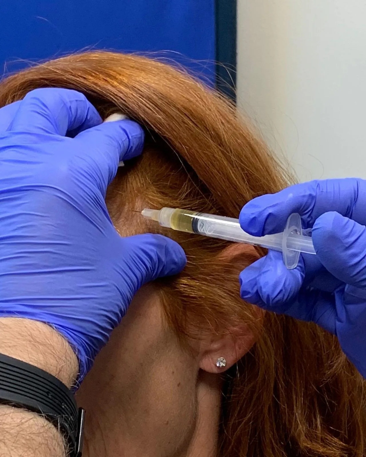 Clinician in blue gloves administering PRP injection to patient's scalp for hair restoration